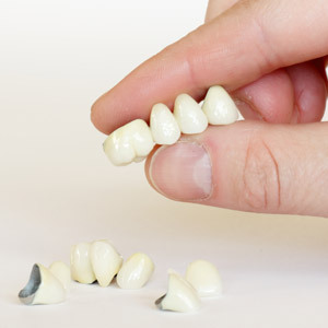傳統固定式假牙